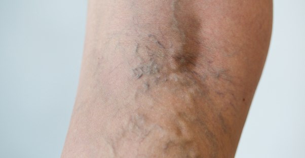 an arm with spider veins