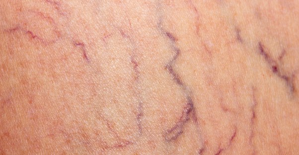The difference between spider veins and varicose veins