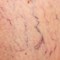 Spider Veins vs. Varicose Veins: What's the Difference? 
