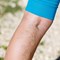 Spider Vein Causes 