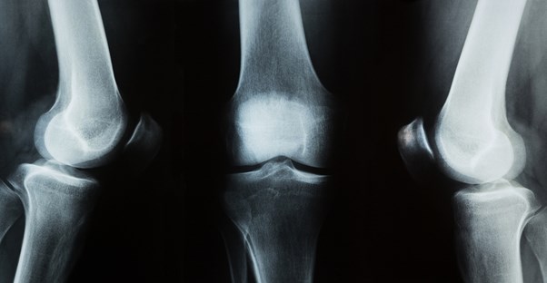 the xray of a person experiencing knee pain symptoms