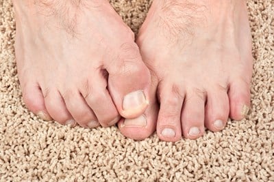 Toenail Fungus: When to Be Concerned 
