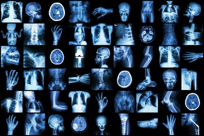 Comparing Glioblastomas to Other Brain Tumors 