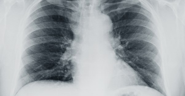 A congested chest