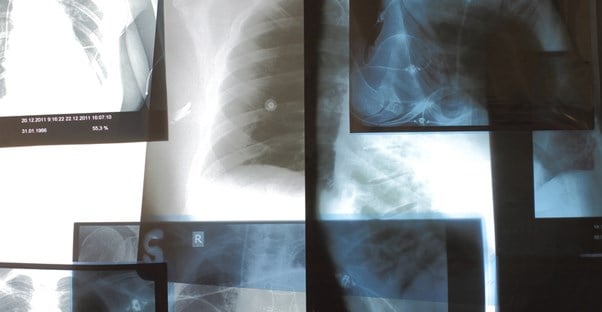 x-rays of chest congestion