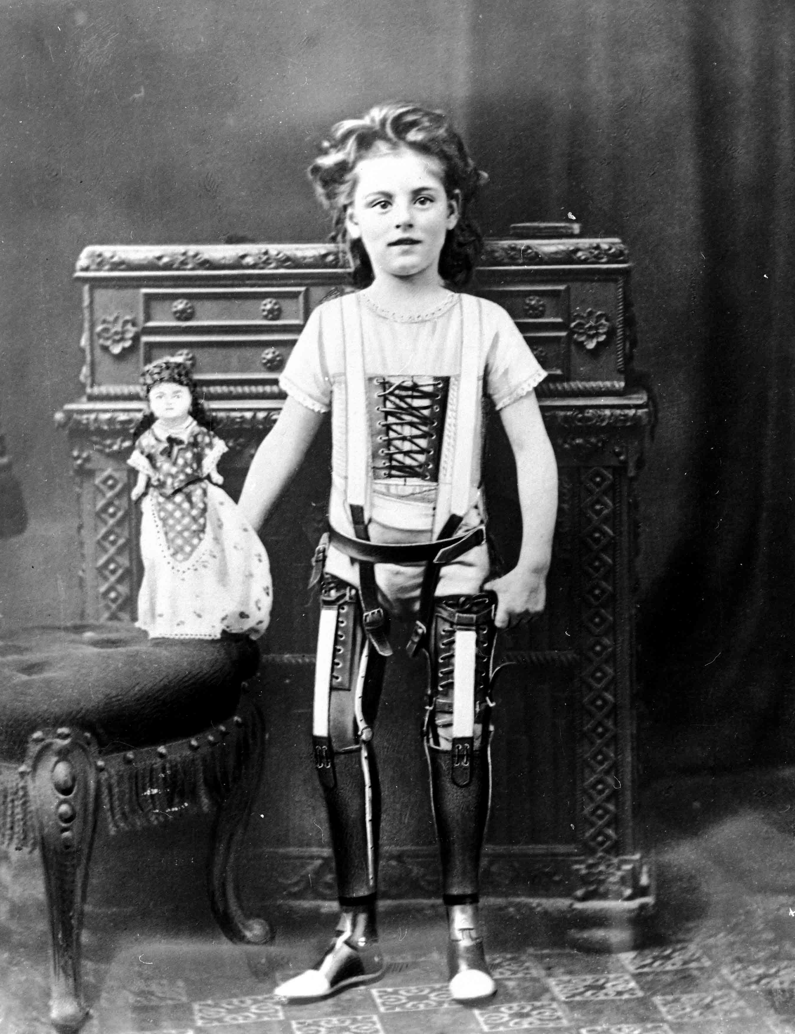 Girl With Artificial Legs, 1890