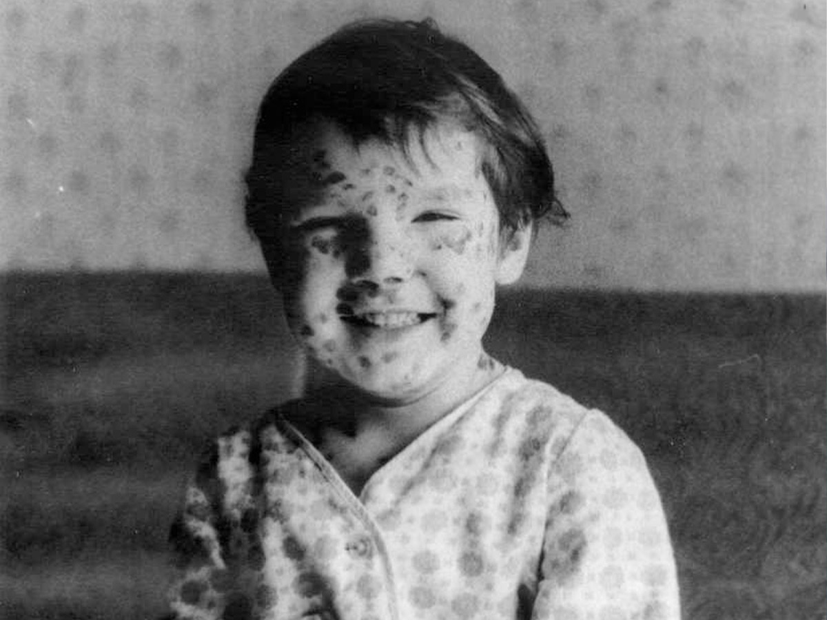 Parents Held Chicken Pox and Measles Parties