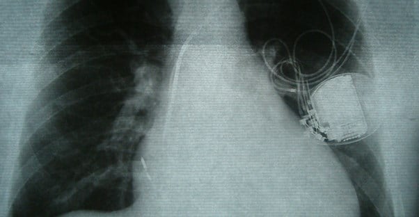 A pacemaker shows up on x-ray