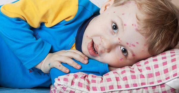 A child ponders his chickenpox