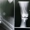 Understanding Different Types of Knee Replacement Surgery