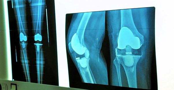 A knee replacement x-ray