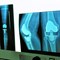 Understanding Total Knee Replacement