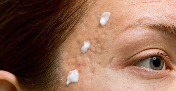 facial scars with cream on them to help them heal