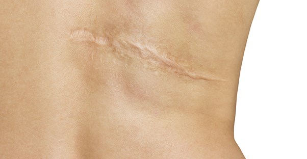 scar on back that needs scar surgery removal