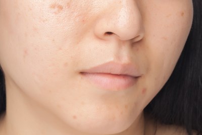 Facial Scar Treatment Home Remedies