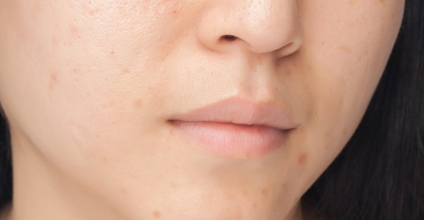 person considering home remedies for their facial scar treatment