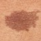 Types of Birthmarks