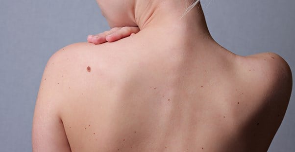 woman considering birthmark removal