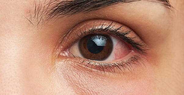 itchy eye that needs home remedies for relief
