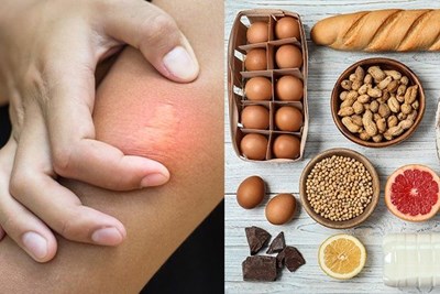 Split photo of an allergic reaction and allergen causing foods