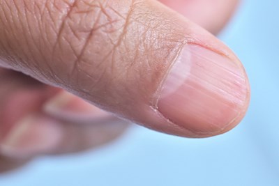 Ridges in your nails may indicate an iron deficiency 