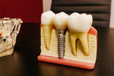 Restore Your Beautiful Smile with Durable Tooth Implants — Nearly Lasts for A Lifetime