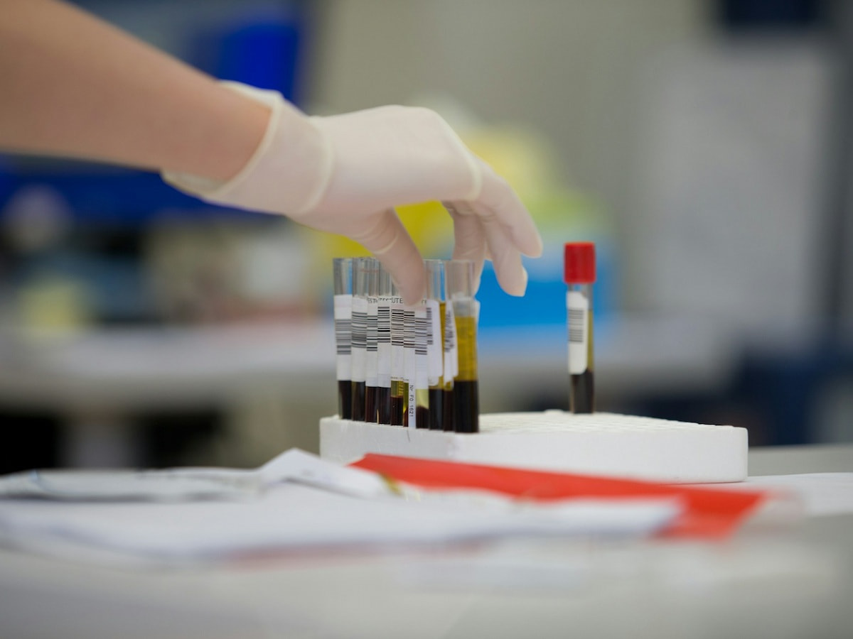 Alzheimer's Gets a Blood Test and New Disease-Slowing Drugs