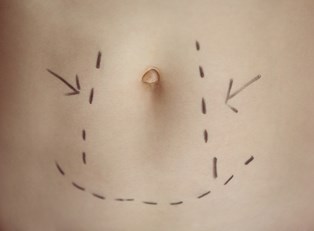 What is a Tummy Tuck?