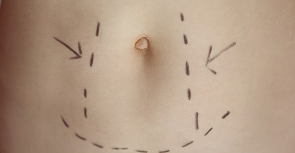 an illustration of what a tummy tuck is