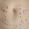 What is a Tummy Tuck?