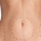 What is Liposuction?