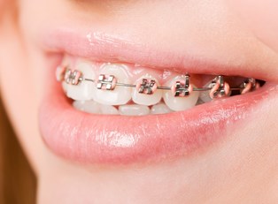 The Cost of Dental Braces