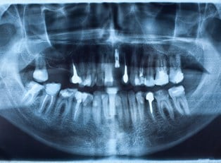 a medical image of permanent dentures