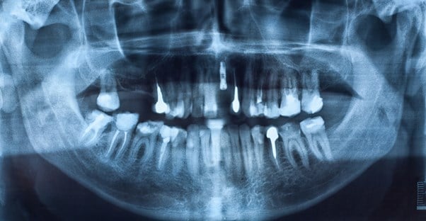 a medical image of permanent dentures
