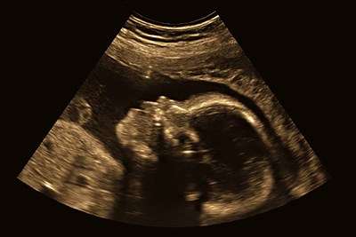 What is an Ultrasound? 