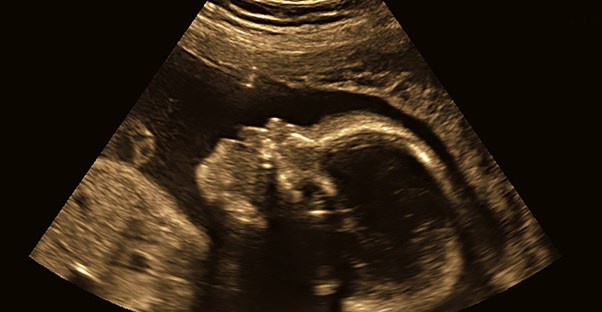 An ultrasound image